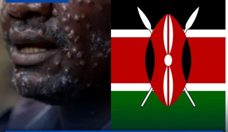 Muri Kenya umuntu wambere yasanganwe Virusi ya Mpox
